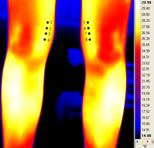 左右膝盖的红外热成像